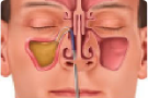 Endoscopic Sinus Surgery